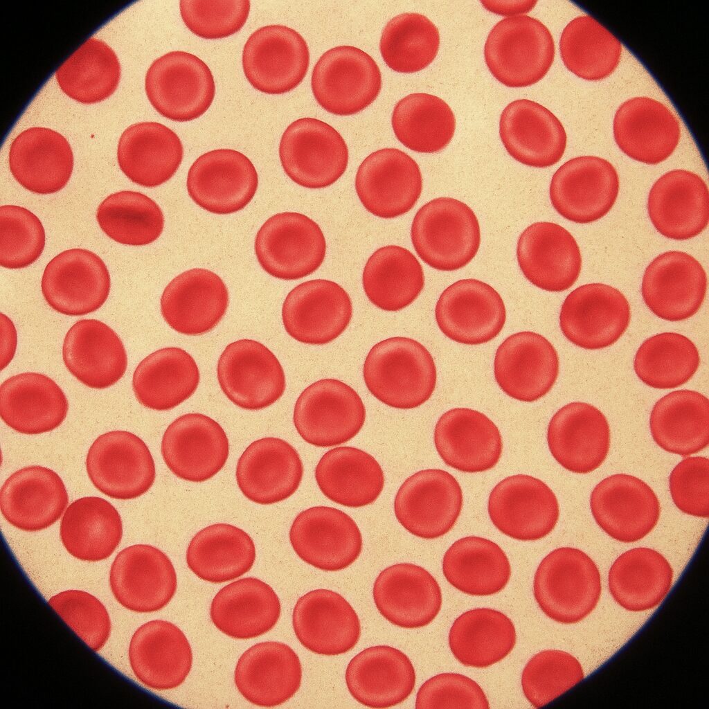 Hemoglobin Düşüklüğü: Nedenleri ve Çözümleri