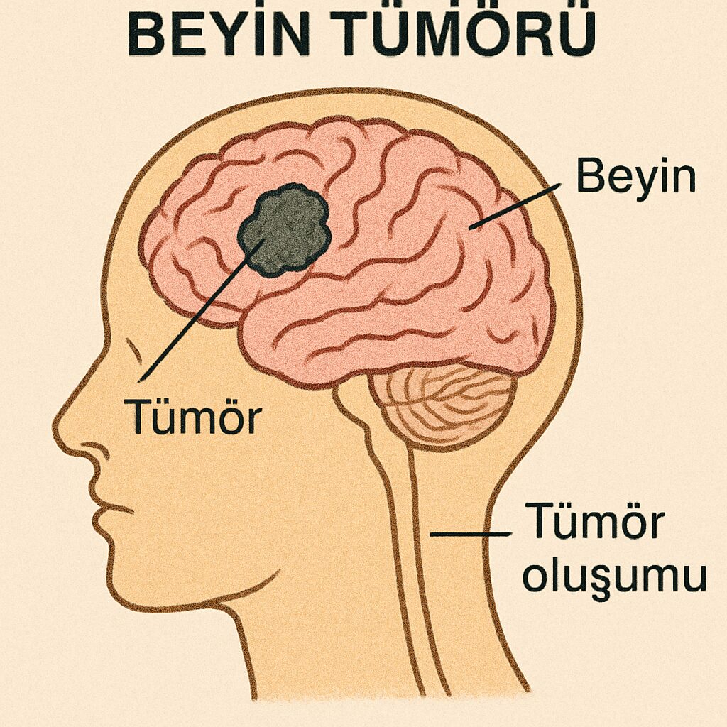 Beyin Tümörlerinin Nedenleri ve Çözümleri