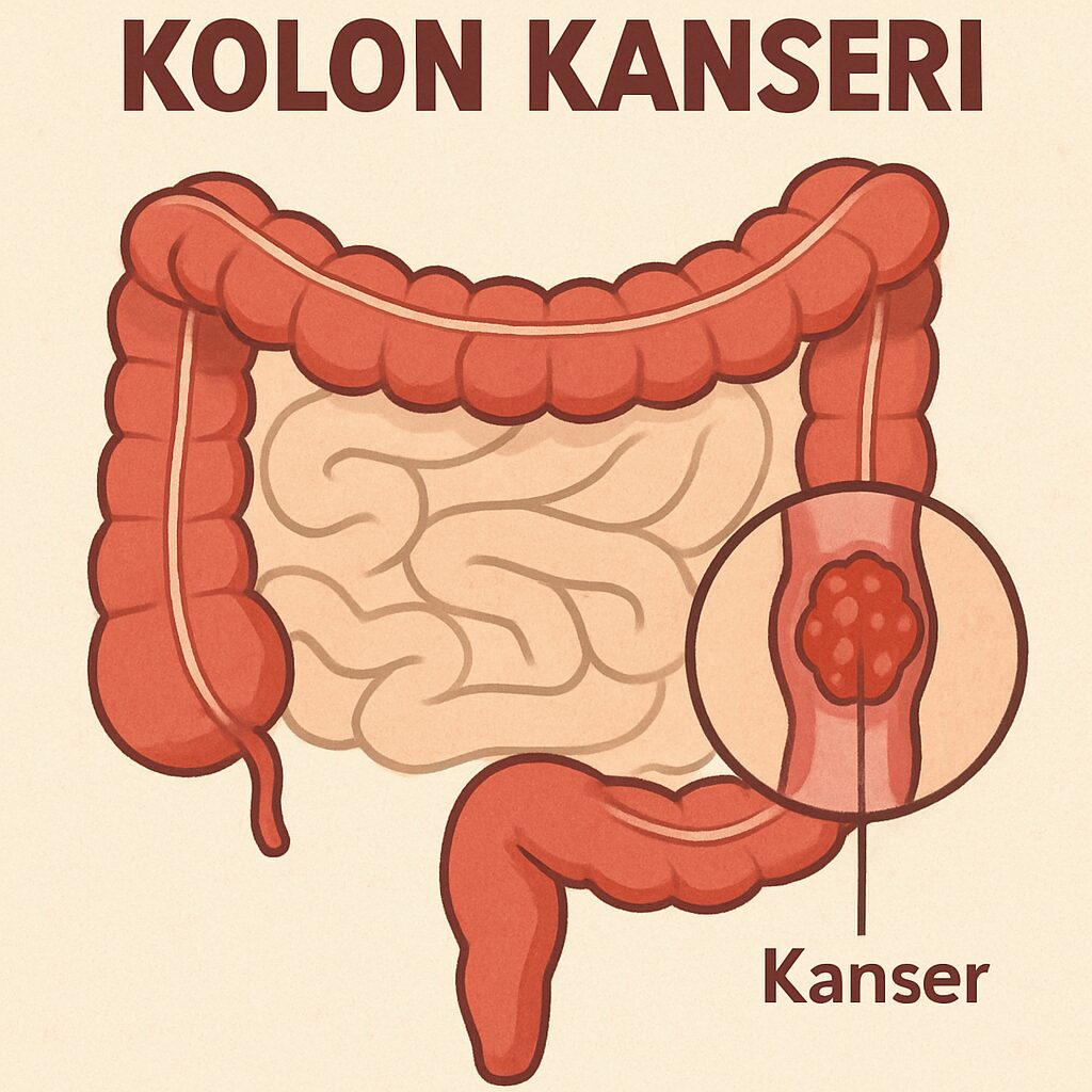 Kolon Kanseri: Nedenleri ve Çözümleri